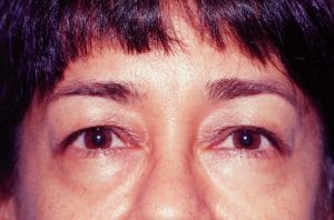 Before lower eyelid blepharoplasty Best Plastic Surgery Before Dr. Wilson performed lower eyelid surgery and restored the crease in the upper eyelid.