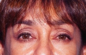 After lower blepharoplasty Best Plastic Surgery after Dr. Wilson performed lower eyelid surgery and restored the eyelid shape