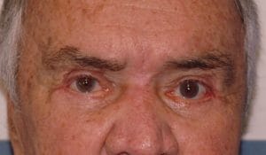 After Eyelid Plastic Surgery After Cosmetic Upper and Lower Eyelid Blepharoplasty