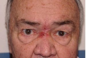 Before Eyelid Plastic Surgery Best Cosmetic Plastic Surgery Upper and Lower Eyelid Blepharoplasty Before