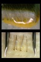 Hair transplantation, Strip technique, Best Plastic Surgery, Nile Cosmetic Center, Follicular Units