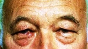 Before Upper and Lower Eyelid Surgery Best Cosmetic Surgery in Egypt, Best Plastic Surgeon, Upper and Lower Baggy Eyelid Surgery Before