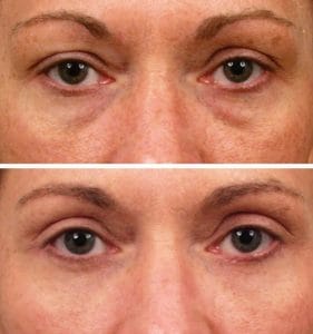 Upper and Lower Blepharoplasty Eyelid Surgery Upper and lower Blepharoplasty Eyelid Surgery at Best Plastic Surgery in Egypt