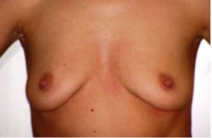 Breast Enhancement Silicon Implants Best Plastic Surgery Egypt Before