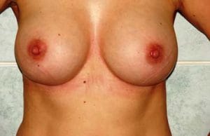 Breast Enhancement Silicon Implants Best Plastic Surgery Egypt After