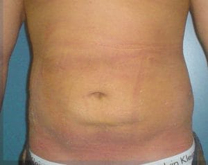 Trunk Vaser High Definition 4D Liposuction and Liposculpture at Best Plastic Surgery Egypt, after