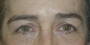 Blepharoplasty_Egypt_before Before Best Cosmetic Surgery egypt upper and lower eyelid surgery. Note the nearly invisible scars, removal of bags and wrinkles