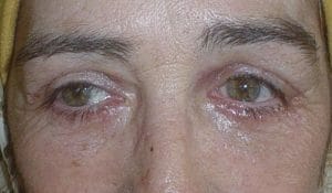 Blepharoplasty_Egypt_After After Best Cosmetic Surgery egypt upper and lower eyelid surgery. Note the nearly invisible scars, removal of bags and wrinkles