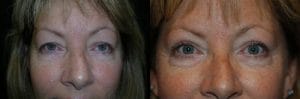 Blepharoplasty_Eyelid_surgery.12503042_std Best Aesthetic Surgery Upper and lower eyelid surgeries were performed and restoration of the normal eyelid contour.