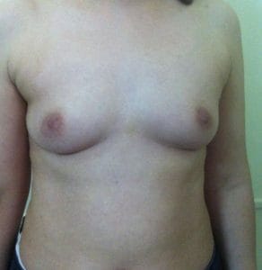Triple Plane Breast Lift Breast Augmentation Breast Mastopexy Best Aesthetic Surgery Egypt Before