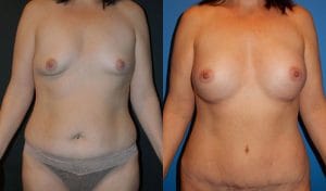 Breast Augmentation Enlargement Enhancement at Best Plastic Surgery in Egypt Before