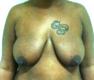 Periareolar Breast Enhancement Breast Lift Breast Augmentation Best Plastic Cosmetic Surgery Egypt Before