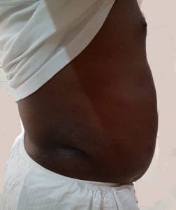 Bulging Abdomen and Flanks treated by Vaser High Definition 4D Liposuction and Liposculpture at Best Aesthetic Surgery in Egypt After