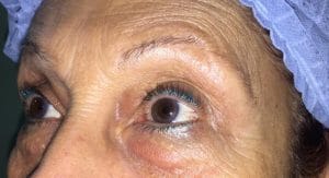 Before Blepharoplasty Best Cosmetic Plastic Eyelid Surgery in Egypt, Baggy eyelids before