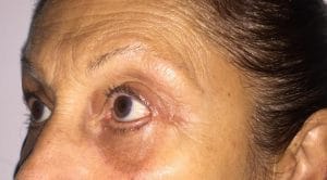 After Blepharoplasty Best Cosmetic Plastic Eyelid Surgery in Egypt, Baggy eyelids after