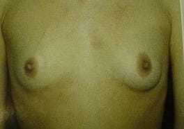 Saline Smooth Implants Breast Augmentation Breast Lift Best Cosmetic Surgery Egypt Before