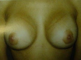 Saline Smooth Implants Breast Augmentation Breast Lift Best Cosmetic Surgery Egypt After