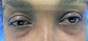 Before upper and lower blepharoplasty Before Dr. Wilson performed upper and lower eyelid blepharoplasty surgery at Best Plastic Surgery in egypt