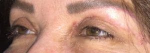 Eyelid-surgery-Blepharoplasty after Prof wilson performed upper eyelid surgery (blepharoplasty) through a skin approach, and totally cured that saggy look in the eyes after side view