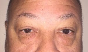 Cosmetic Eyelid Lift blepharoplasty Before Plastic Surgery baggy eyelids and reverse the sunken appearance