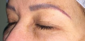 Eyelid_surgery_Blepharoplasty_before Prof wilson performed upper eyelid surgery (blepharoplasty) through a skin approach, and totally cured that saggy look in the eyes side view before