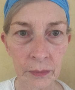 Face_and_Neck_Lift_ drooping jowls, Sagging Face and Neck
