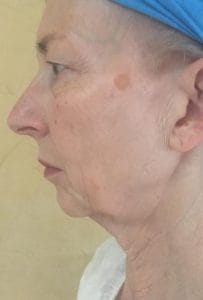 Face_and_Neck_Lift_ Drooping jowls, eye bags, sagging neck and puffy eyelids