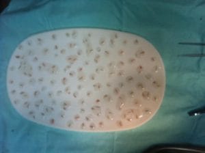 FUE Follicular Units Extraction at Best Cosmetic Surgery at Nile Cosmetic Center