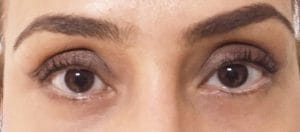 After lower eyelid surgery After Dr. Wilson performed lower eyelid surgery (blepharoplasty) through a skin approach, and totally cured that baggy look in the eyes