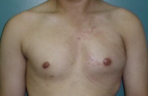 Hypoplastic Breast, Best Plastic Cosmetic Surgery in Egypt, male Breast Implants, After