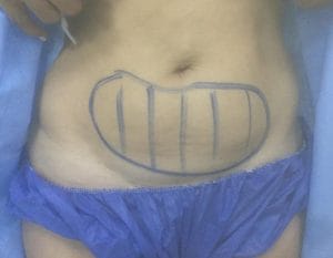Lax abdomen and Love Handle Vaser High Definition 4D Liposuction and Liposculpture at Best Cosmetic Surgery in Egypt Before