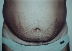 Tummy 6 packs Vaser High Definition 4D Liposuction at Best Cosmetic Plastic Surgery Egypt before