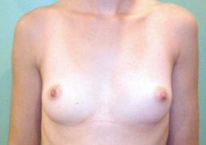 Breast Augmentation Silicon Implants Areola Incision Best Plastic Surgery Egypt Before