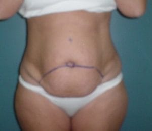 Overhanging Belly and Love Handle Vaser High Definition 4D Liposuction at Best Plastic Surgery Egypt Before