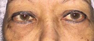Before upper and Lower Eyelid Blepharoplasty Lower Eyelid Surgery and Fat Grafting at Best Cosmetic Surgery Before