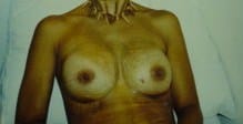 Silicon Implants Breast Augmentation Breast Lift Best Aesthetic Surgery Egypt After