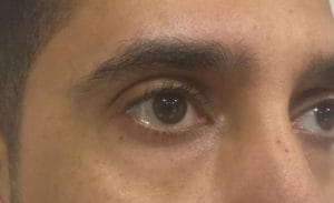 Lower Eyelid surgery after faulty Restylane Injection Best Cosmetic Surgery Dr. Wilson performed lower eyelid surgery and restored the normal eyelid contour.