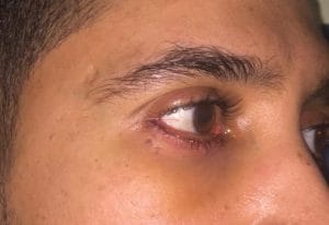 Lower eyelid surgery Best Cosmetic surgey after Dr. Wilson performed lower eyelid surgery and restored the normal eyelid contour.