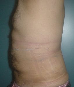 Tummy 4 packs Vaser High Definition 4D Liposuction at Best Cosmetic Surgery Egypt after