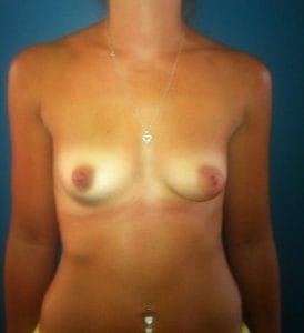 Atrophic Breast Enlargement Best Aesthetic Plastic Surgery Egypt Before