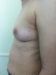 Triple Plane Breast Lift Breast Augmentation Breast Mastopexy Best Aesthetic Surgery Egypt Before side viev