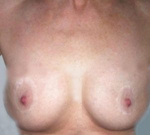 Revision Breast Enhancement Breast Lift Best Plastic Cosmetic Surgery Egypt Fat Grafting After