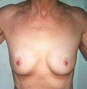 Revision Breast Enhancement Breast Lift Best Plastic Cosmetic Surgery Egypt Fat Grafting Before