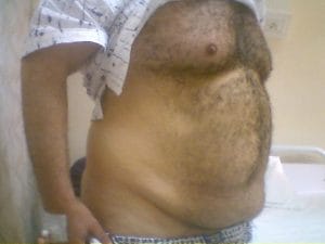 Circumferential Vaser High Definition 4D Liposuction at Best Plastic Surgery in Egypt Before