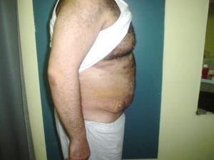 Circumferential Vaser High Definition 4D Liposuction at Best Plastic Surgery in Egypt After