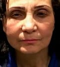 After FaceLift and Relocation of Facial Fat After skin sagging and baggy eyelids. A full face lift and relocation of facial fat at Best Plastic Surgery Egypt