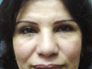 Before baggy lower eyelids and lower blepharoplasty Before Best Plastic Surgery baggy lower eyelids and lower blepharoplasty puffed lids