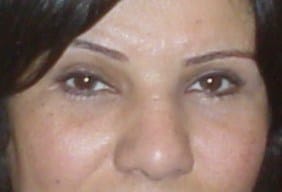 Best lower Eyelid Plastic Surgery After Best Plastic Eyelid Surgery on baggy lower eyelids and lower blepharoplasty puffed lids