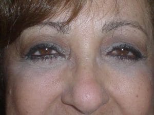 Upper-lower-eyelid-surgery-Egypt After Best Plastic Surgery egypt Upper and Lower Eyelid Surgery Baggy eyelids