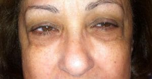 Plastic-Surgery-eyelids-before Before Best Plastic Surgery egypt Upper and Lower Eyelid Surgery Baggy eyelids